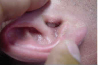 Ear Canal Image